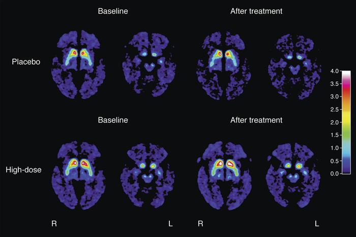PET scans show dopamine signal activity before and after treatment with PDGF - white areas mean higher activity. Source: Lund University