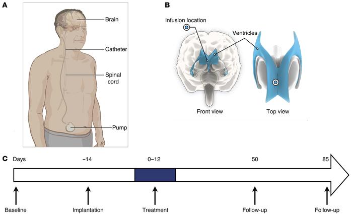 Position of the catheter to introduce PDGF and timing of the study